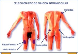 Sitios de punción intramuscular